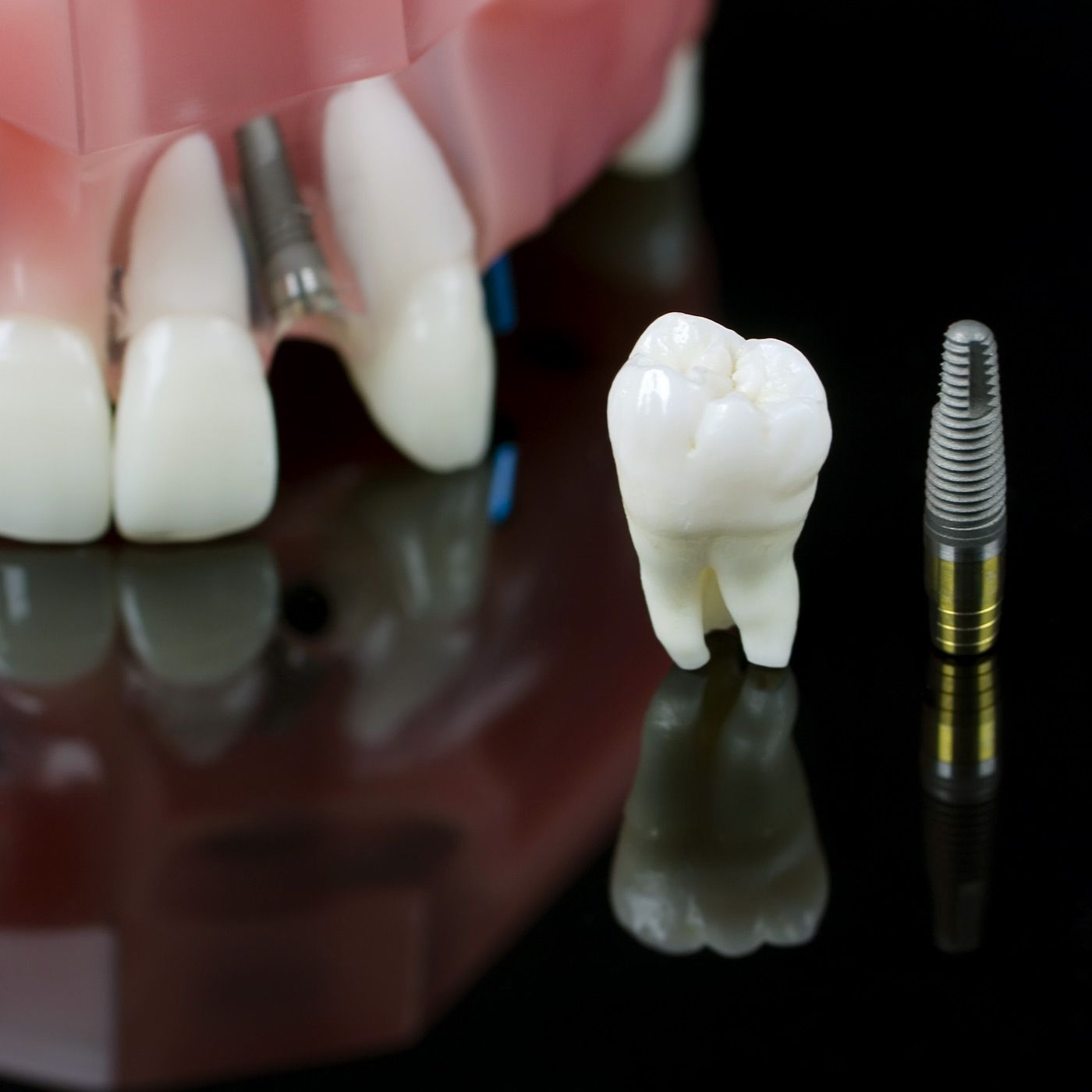 Dental implants