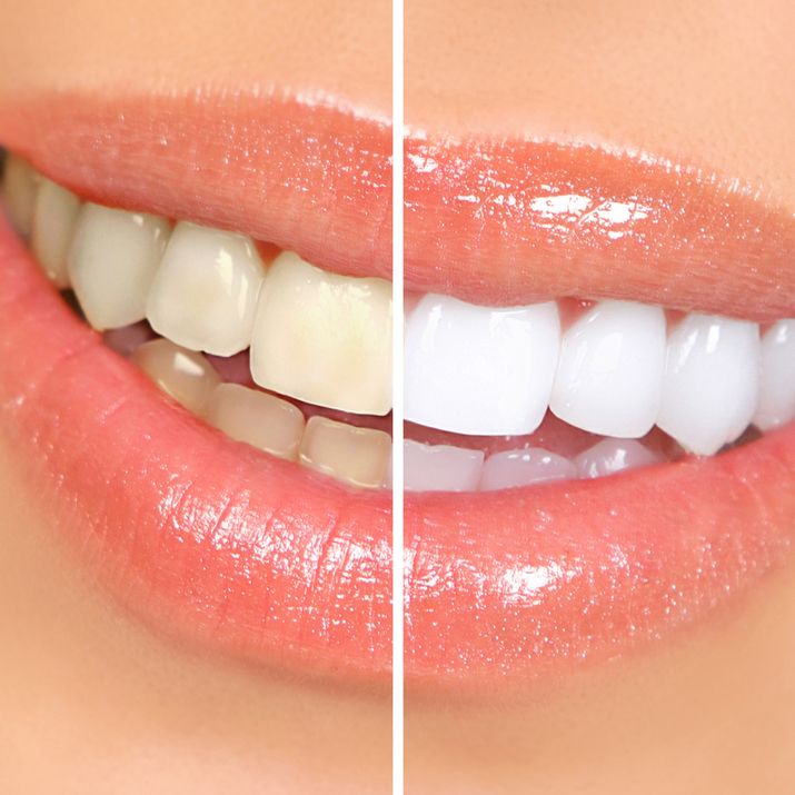 Closeup of woman's smile before and after professional teeth whitening