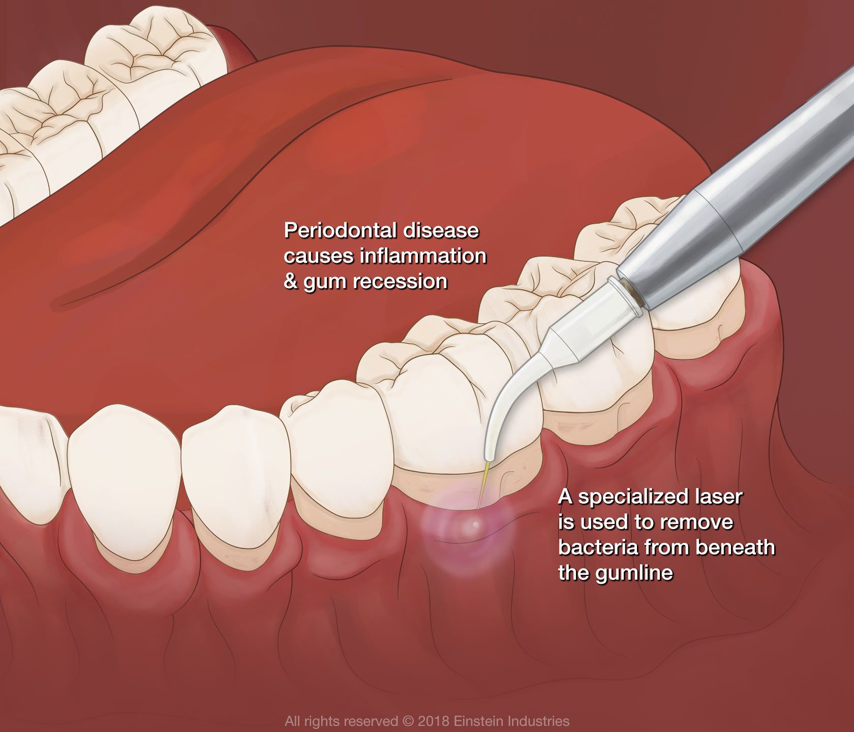 Illustration of gum disease
