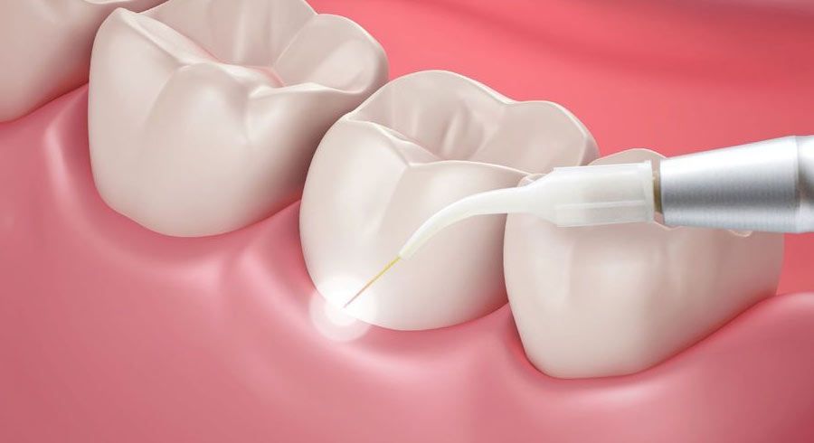 Waterlase® laser dentistry.