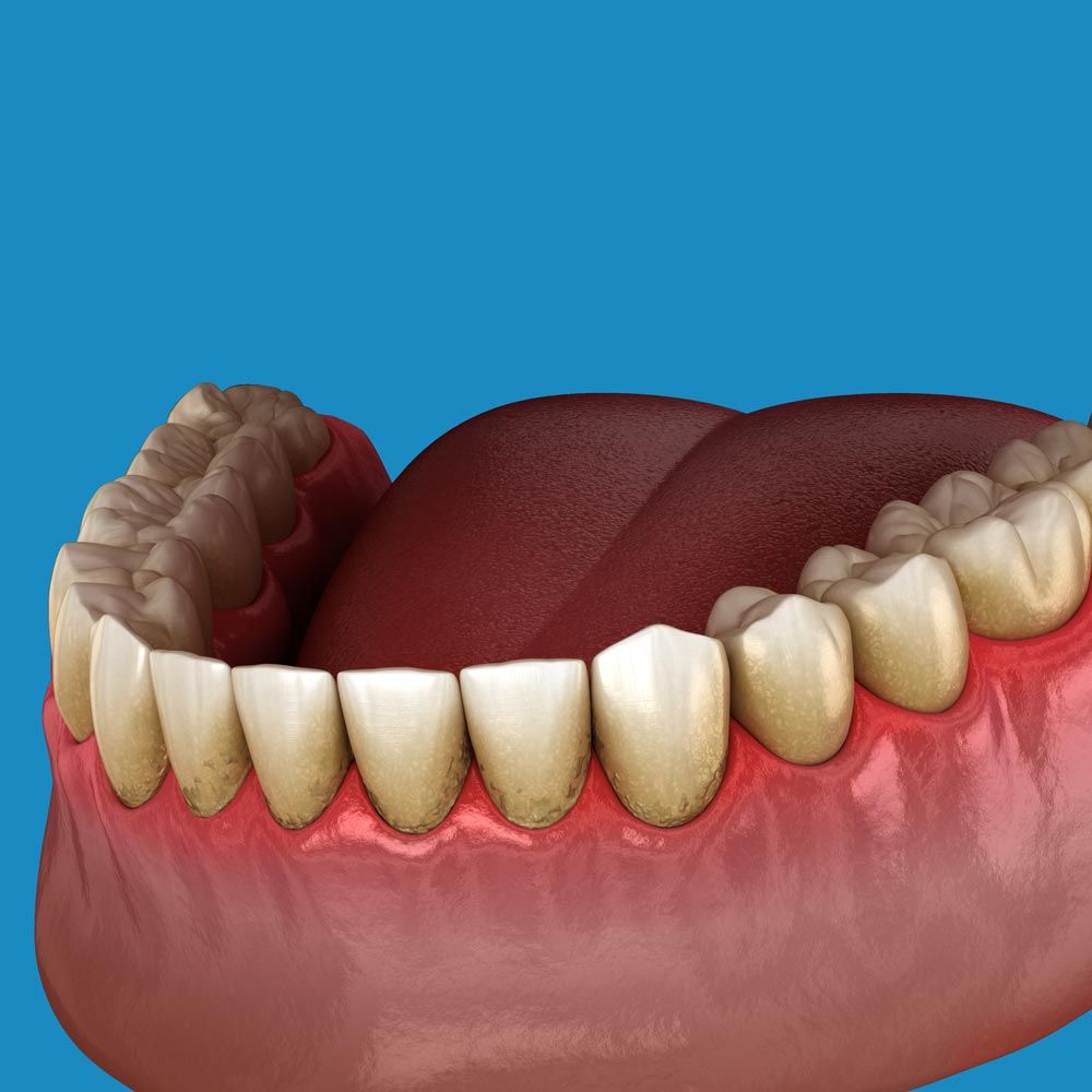 Illustration of gum disease