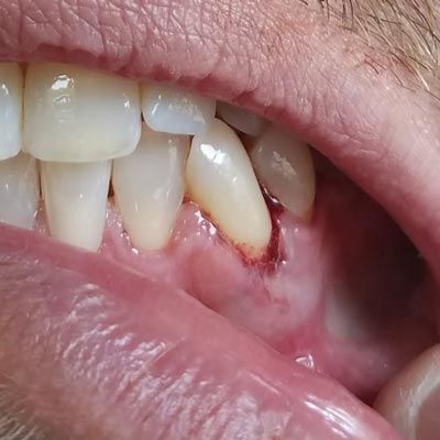Bleeding gums
