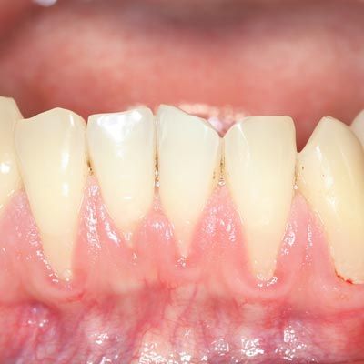 Recessed gums