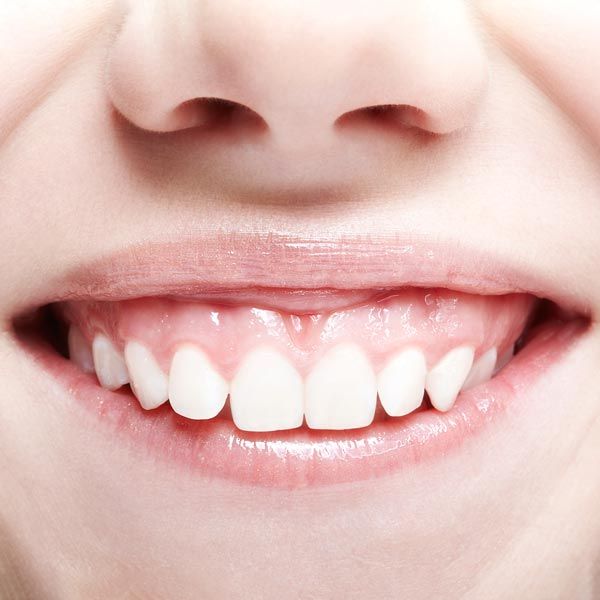 Patient with receded gums